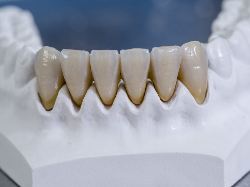 Monolithic zirconia crown — CAD/CAM dental lab Sydney